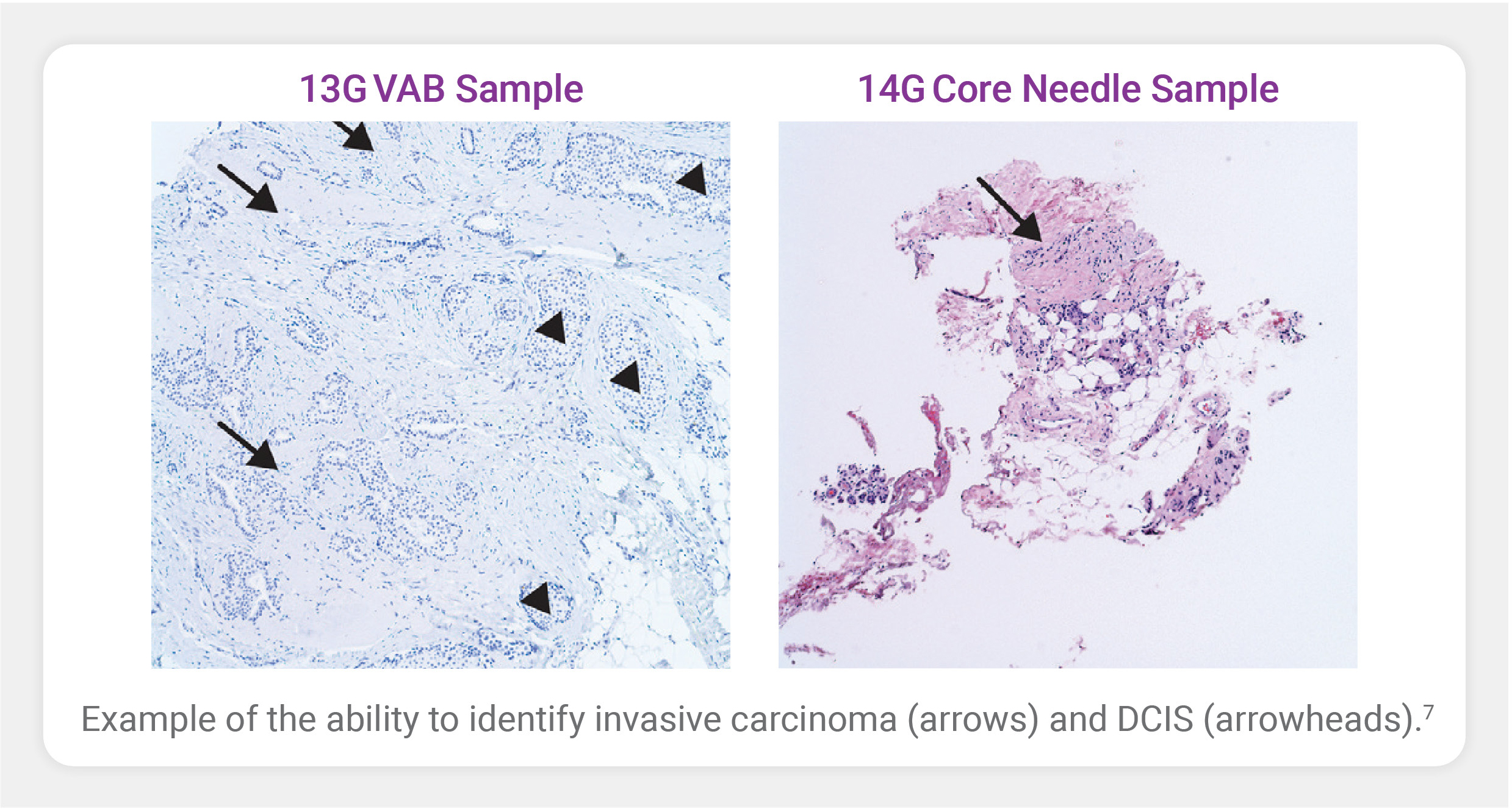 Example of the ability to identify invasive carcinoma and DCIS